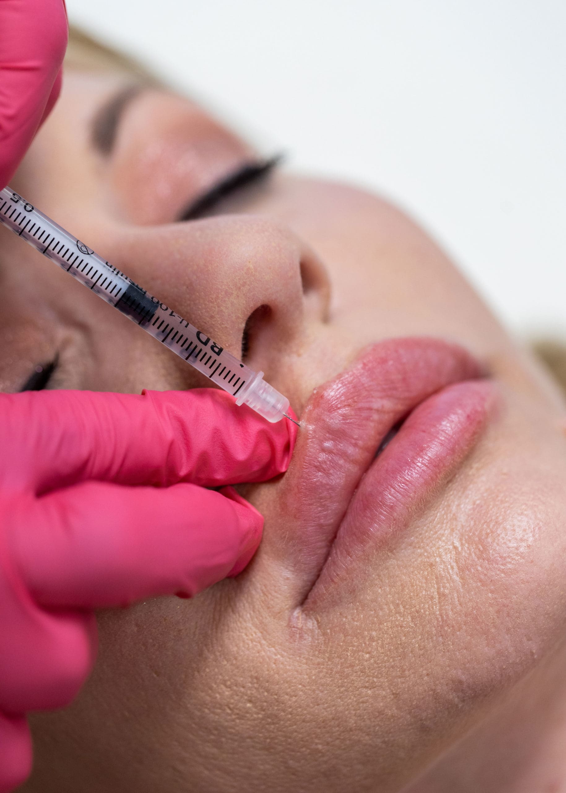 SKN-Injectable-Filler