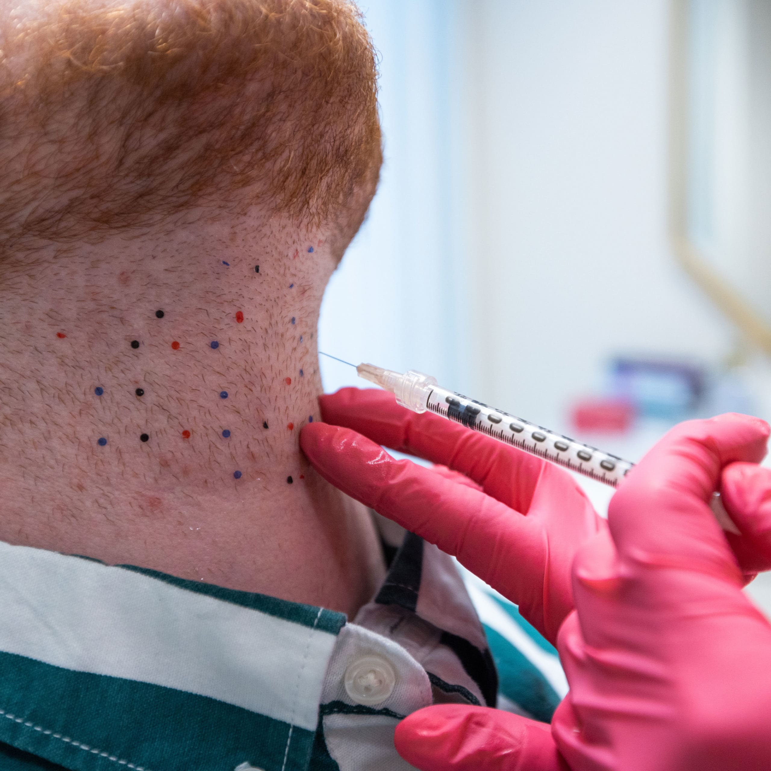 Closeup of patient's neck receiving Deoxycholic Acid injection