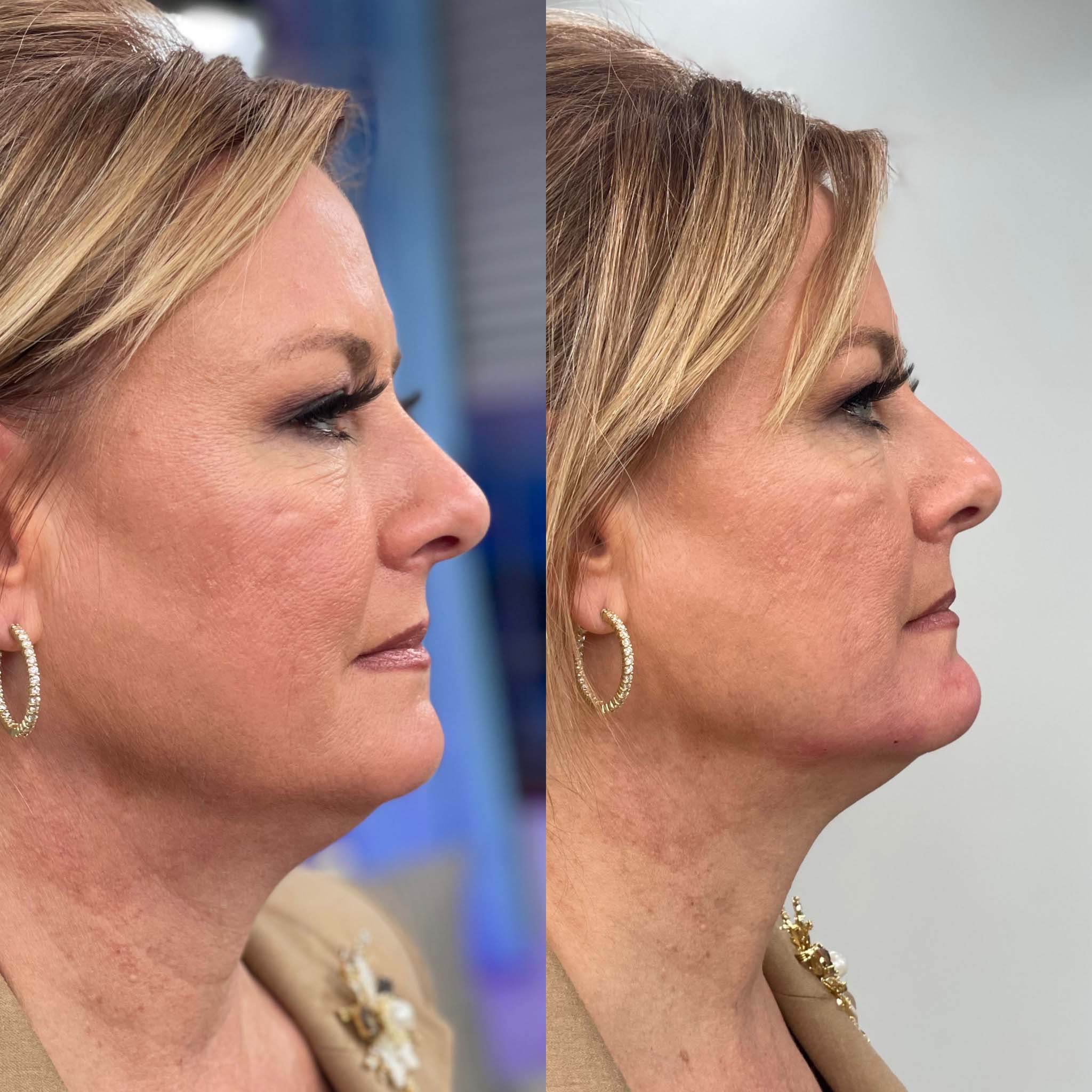 Chin filler before and after right side view