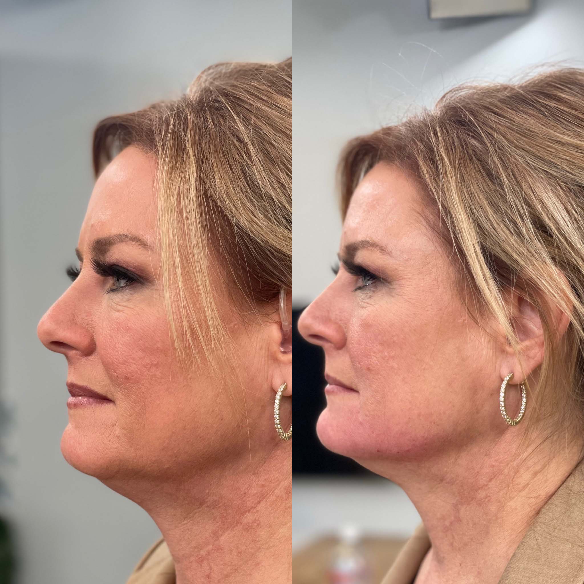 Chin filler before and after left side view