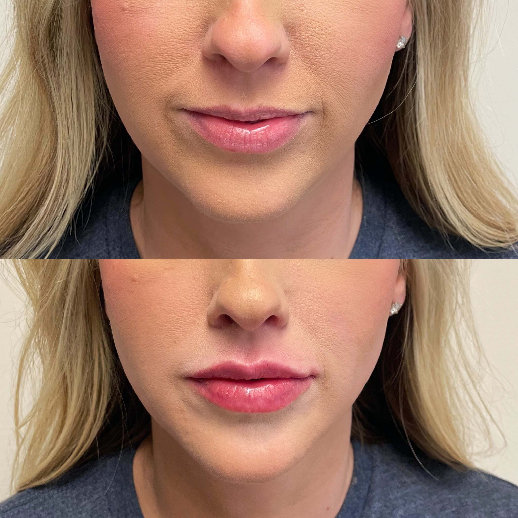 Closeup view of lip filler before and after