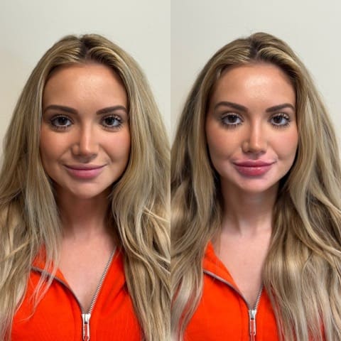 Front view of lip filler before and after