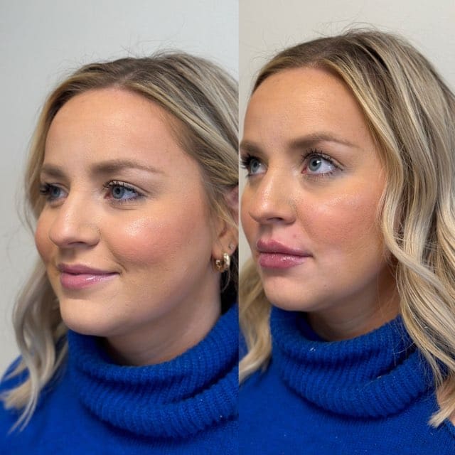 Lip filler before and after angled view with obviously fuller lips afterward