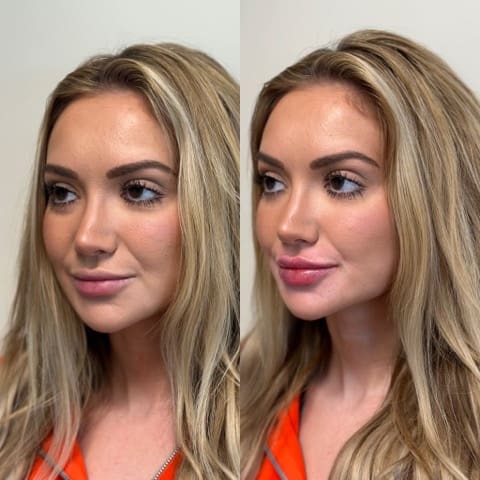 Angled view of lip filler before and after showing fuller lips