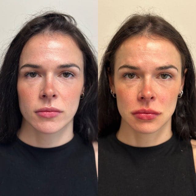 Lip filler before and after headshot