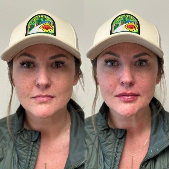 Patient in baseball cap showing before after with fuller lips post-procedure