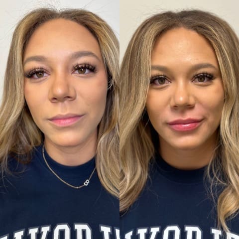 Lip filler before and after showing fuller lips after