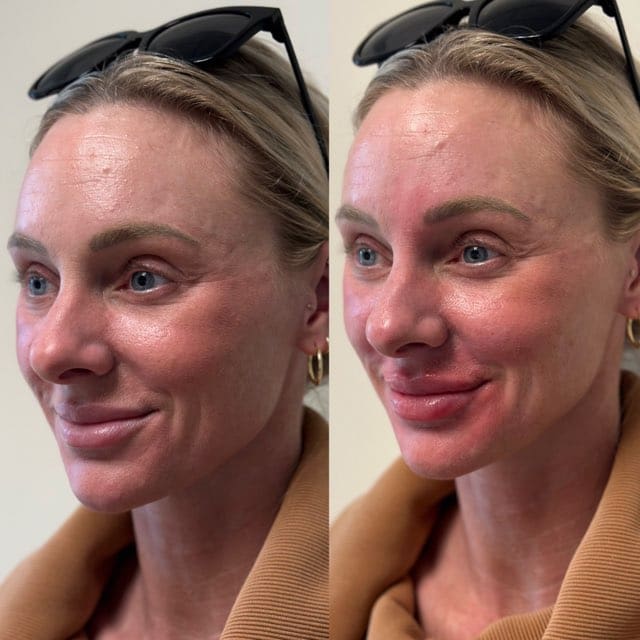 Lip filler before and after, side view