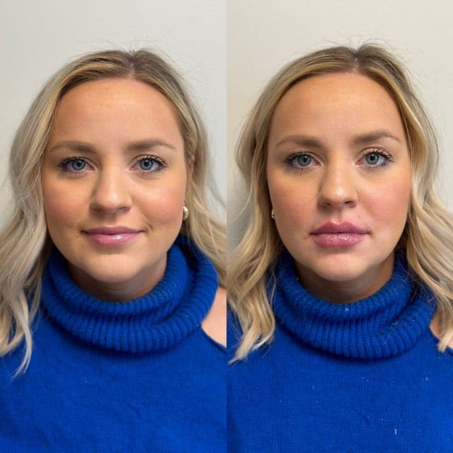 Lip filler before and after - smiling woman with fuller lips after