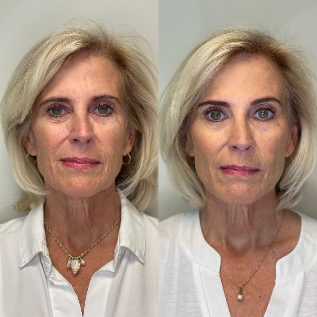 Front view PDO thread before and after headshots showing subtly tighter skin