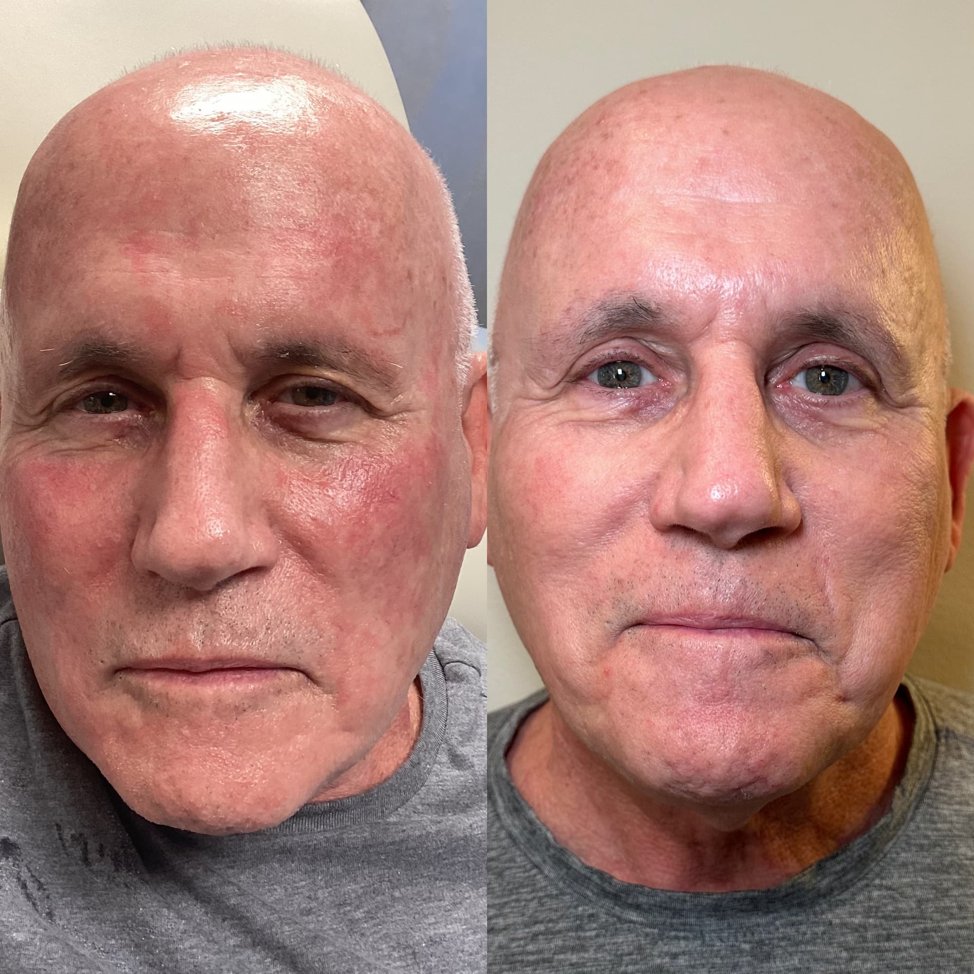 Man's face front view before and after showing results of BBL and HALO - removal of discolored red patches of skin