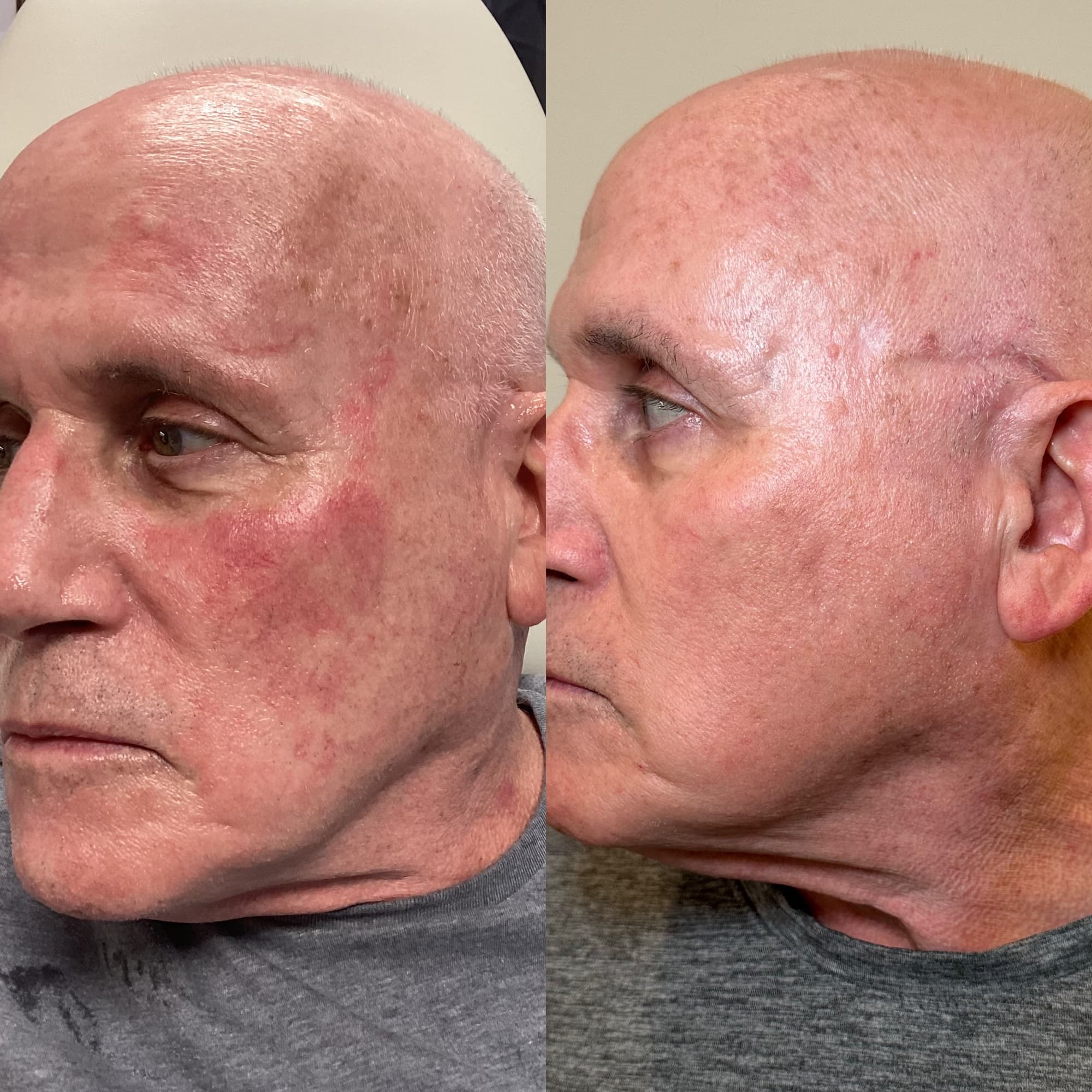 Man's face left side view before and after showing results of BBL and HALO - removal of discolored red patches of skin