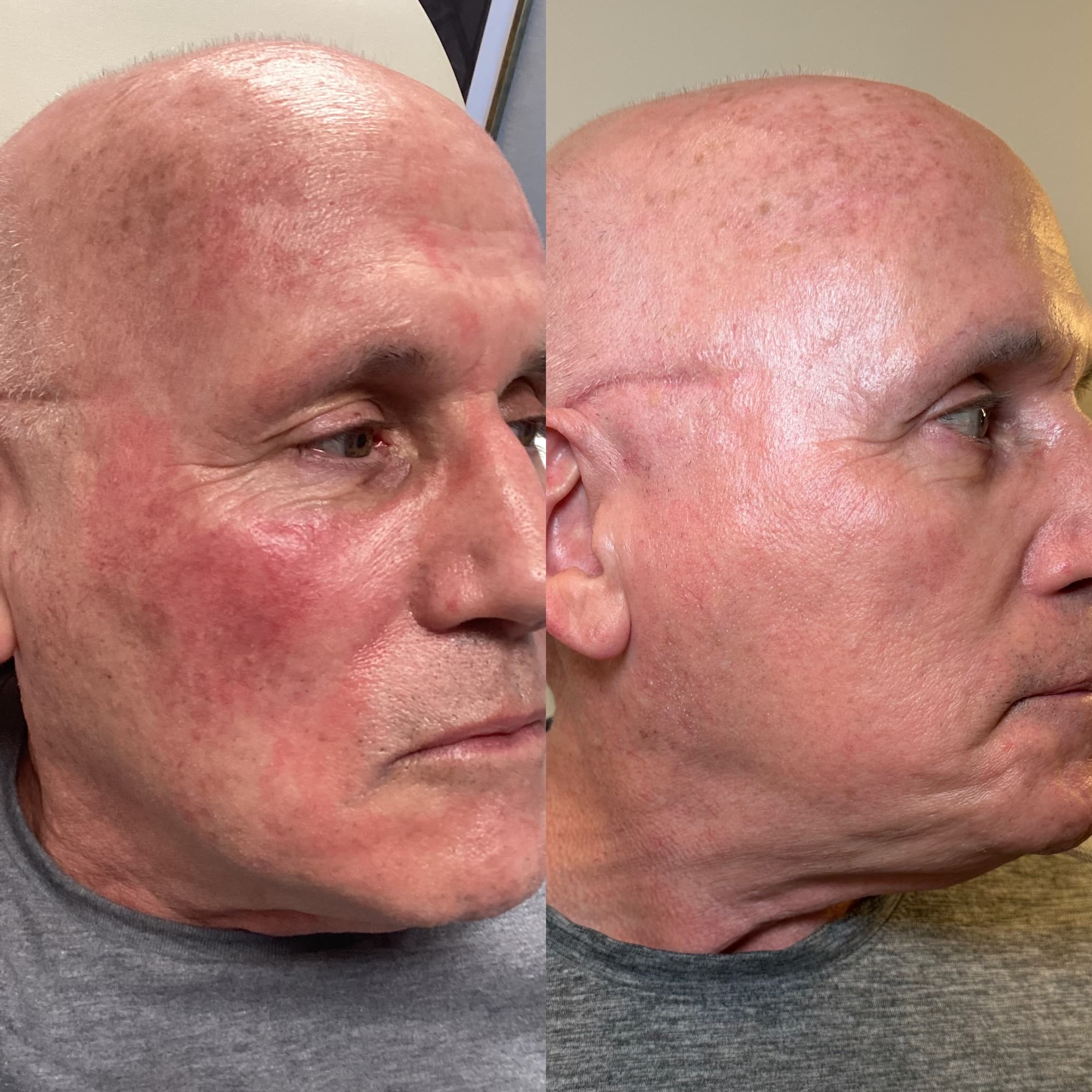 Man's face right side view before and after showing results of BBL and HALO - removal of discolored red patches of skin