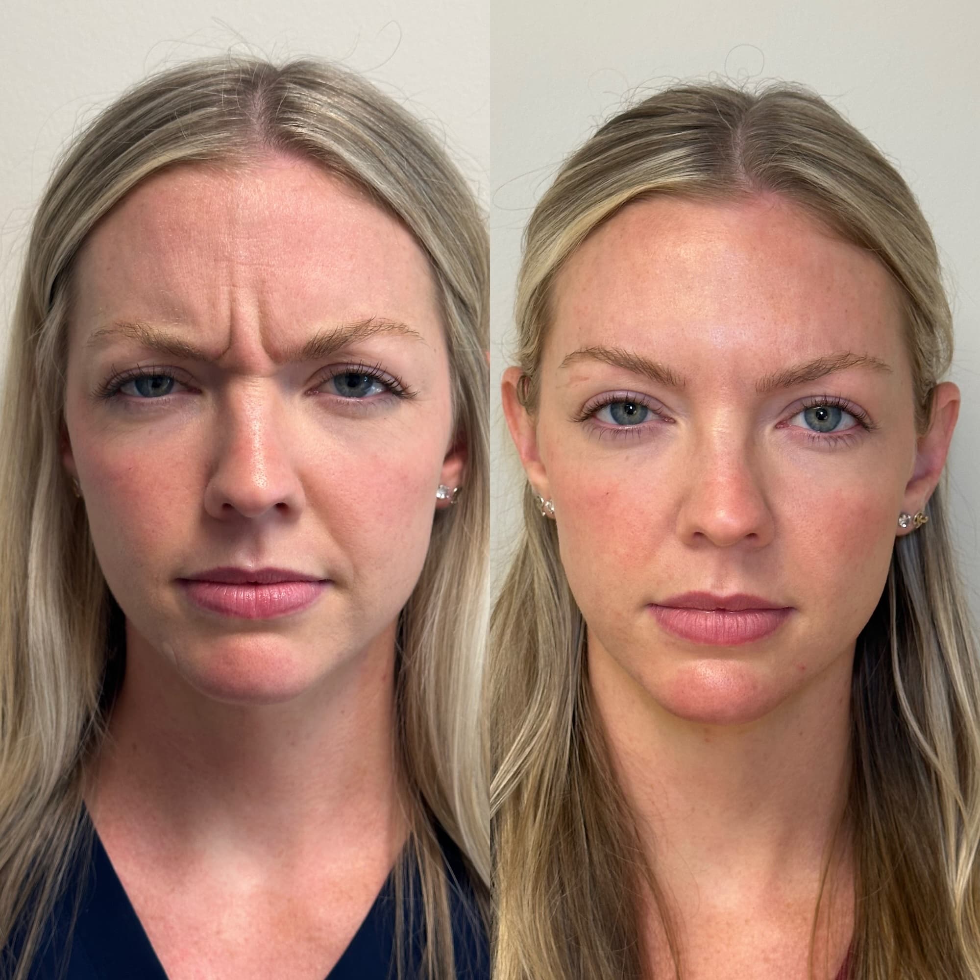 Woman's face front view before and after showing results of Dysport - fewer frown lines