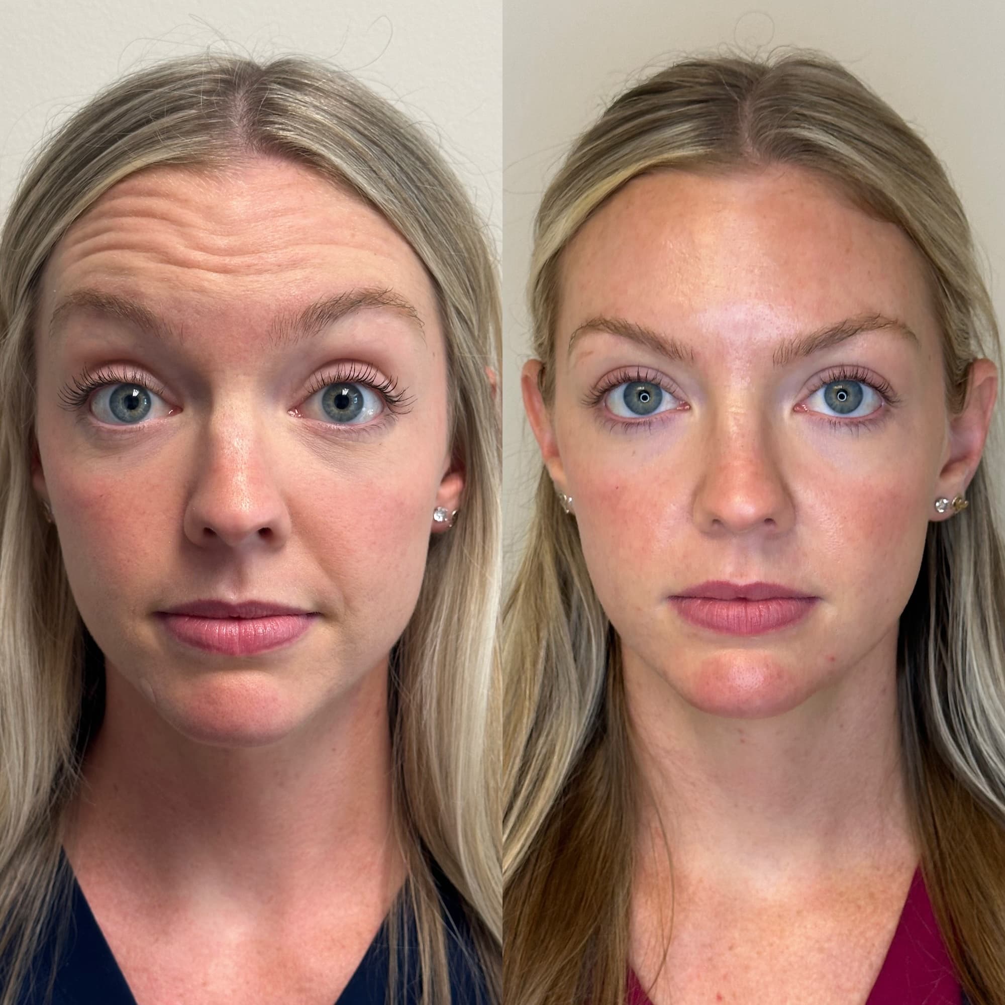 Woman's face front view before and after showing results of Dysport - fewer forehead wrinkles with raised eyebrows