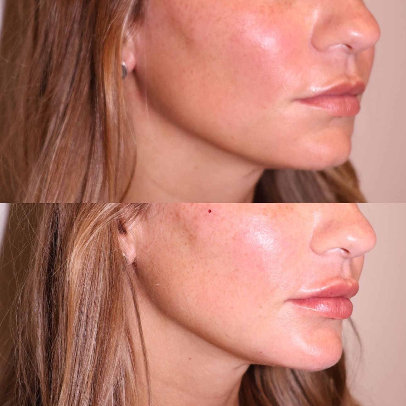 Women's face closeup showing results of lip and chin filler