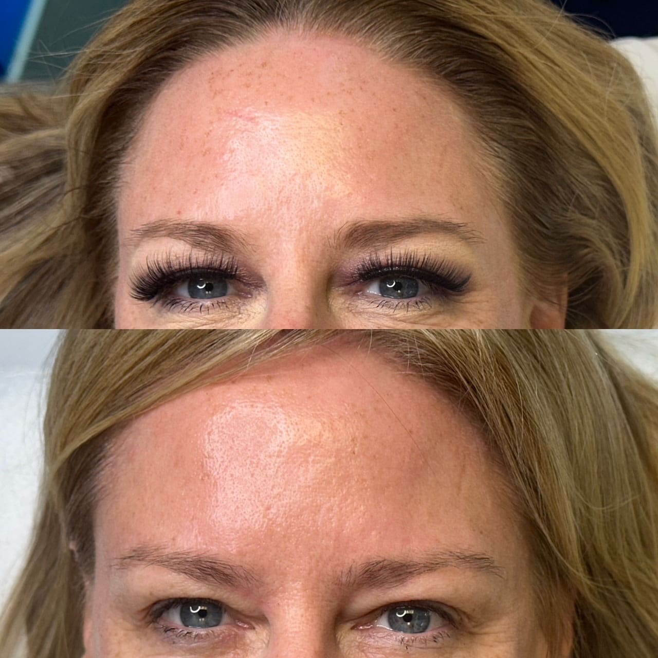 Patient before and after BioRePeel, front closeup view of forehead