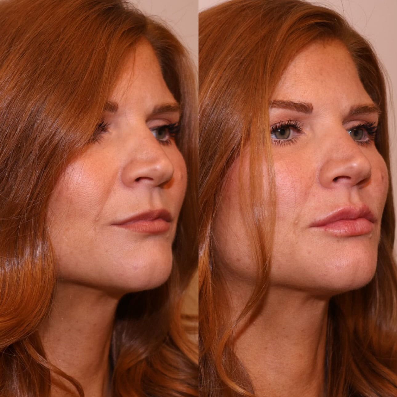 Patient before and after lip filler, side view