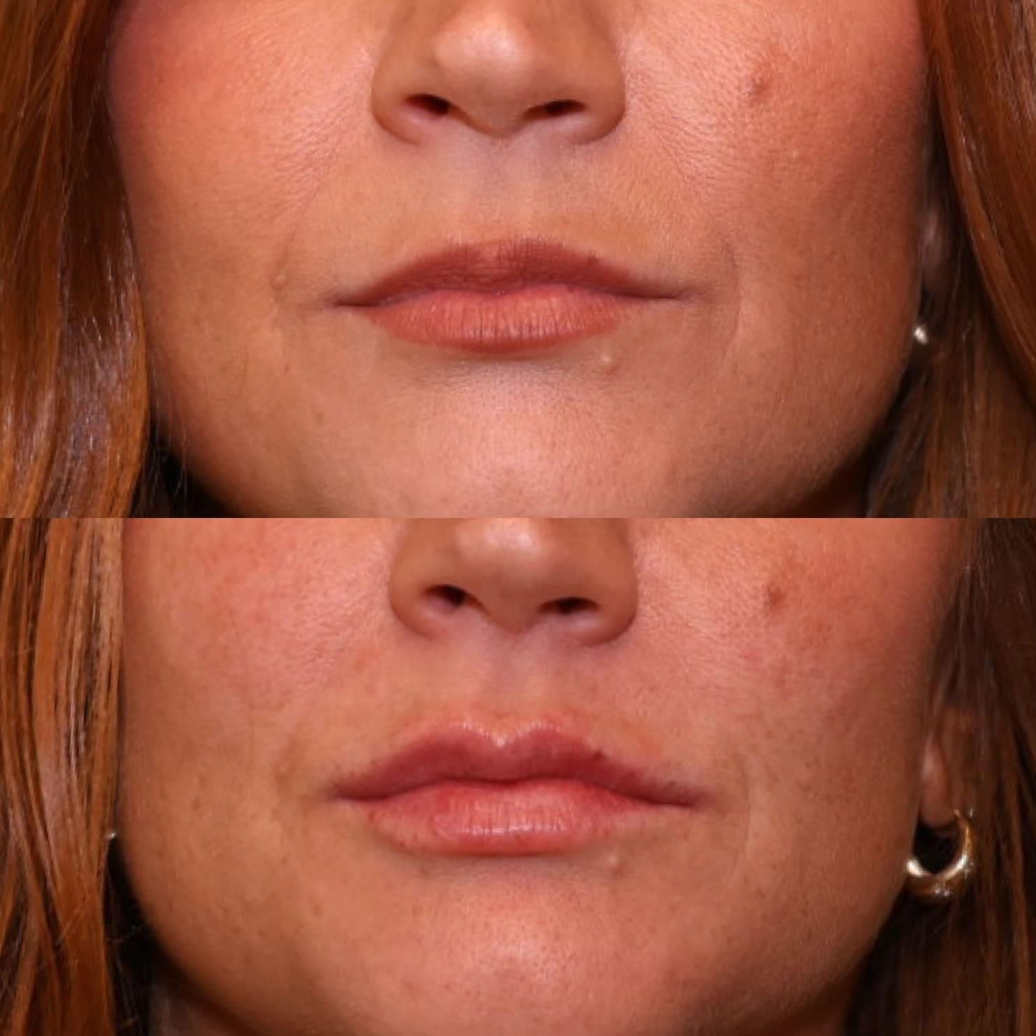 Patient before and after lip filler, front closeup view