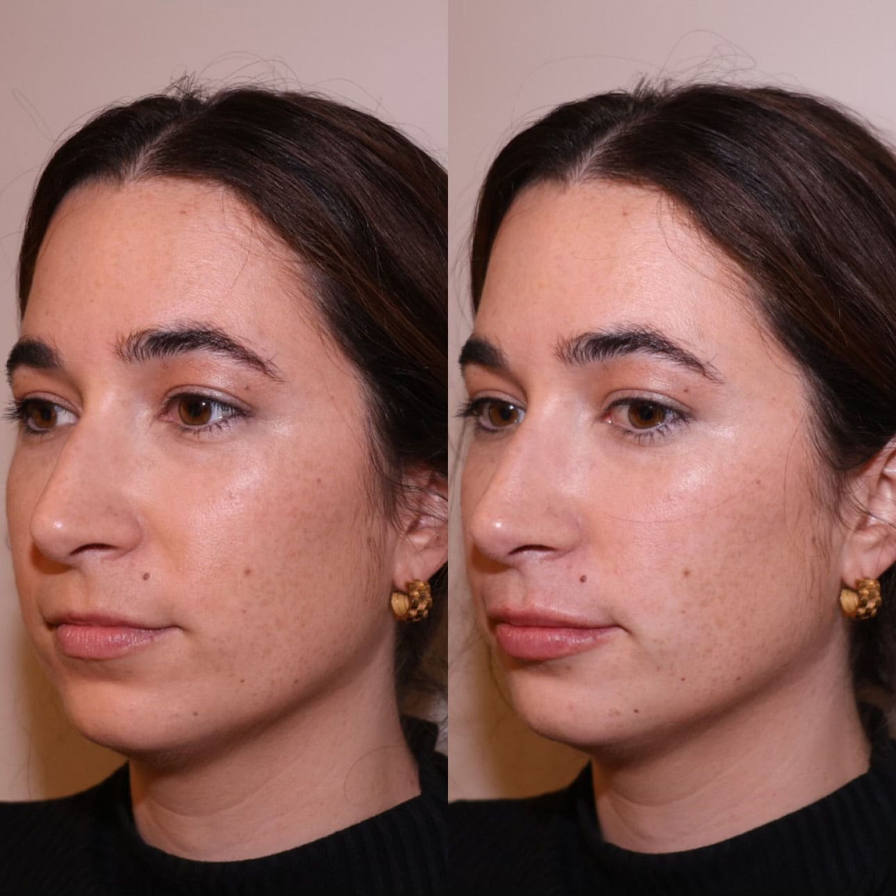 Patient before and after mini lip plump filler