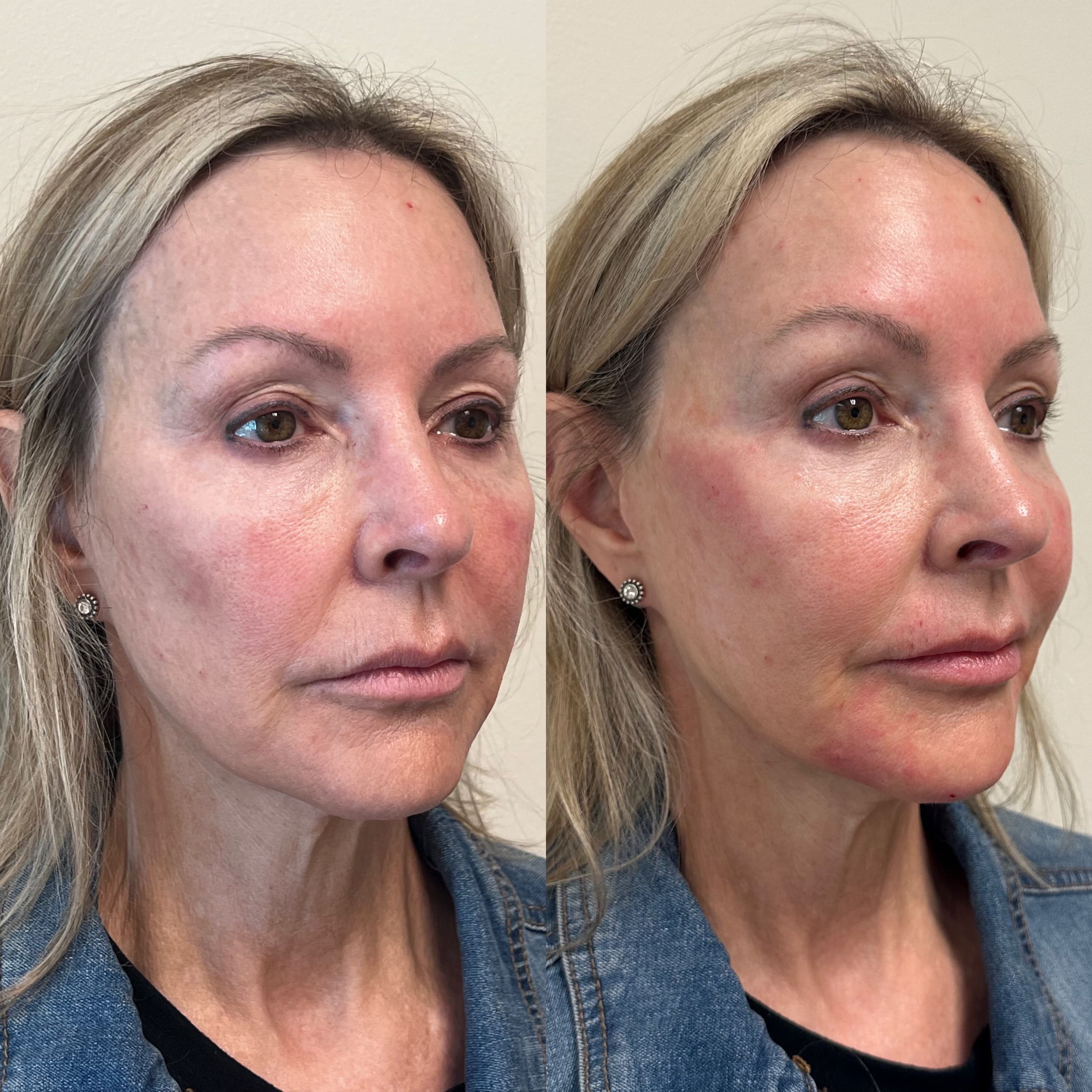 Before & after: cheek filler - side angle view