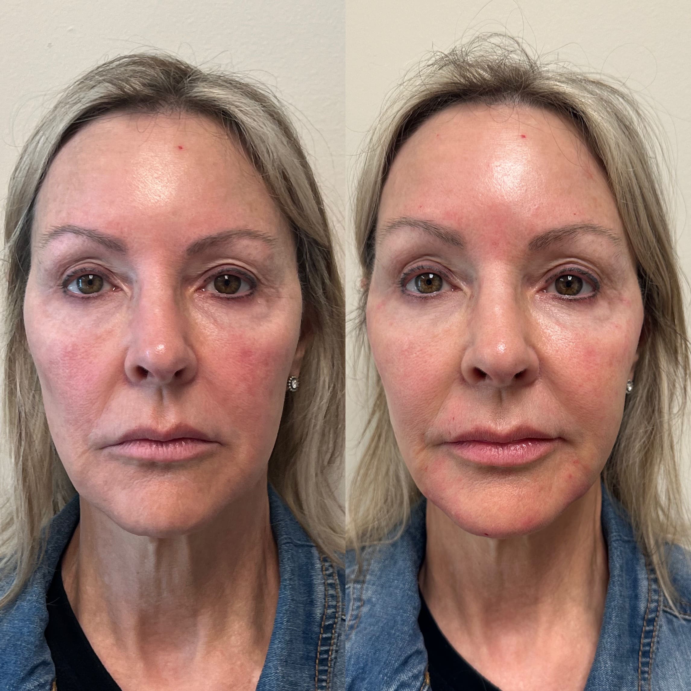 Before & after: cheek filler - front view