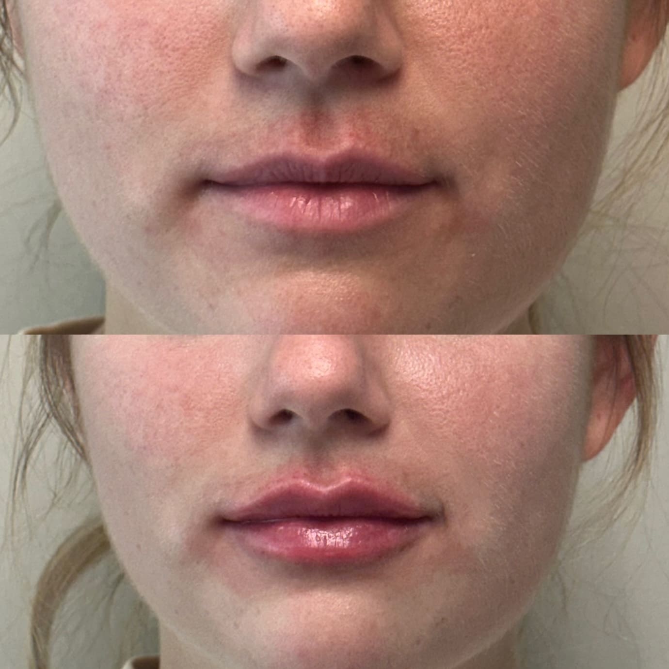 Before and after - lip filler front view