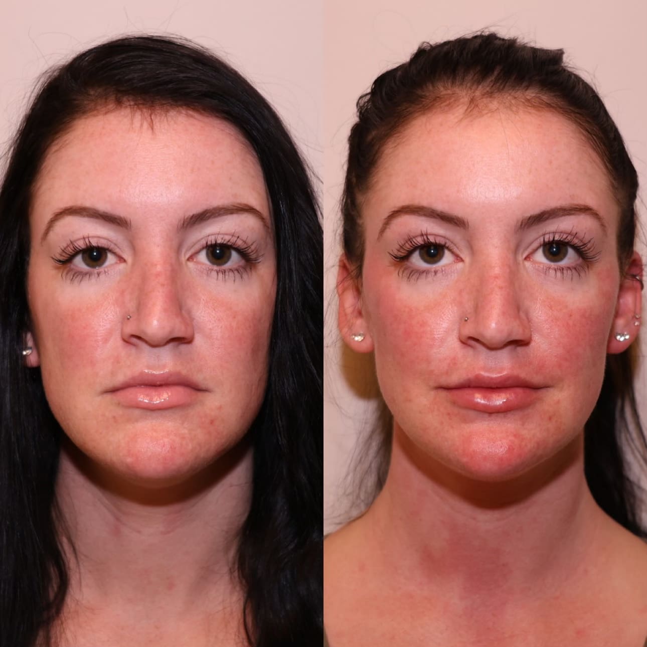 Before and after - lip and cheek filler front view