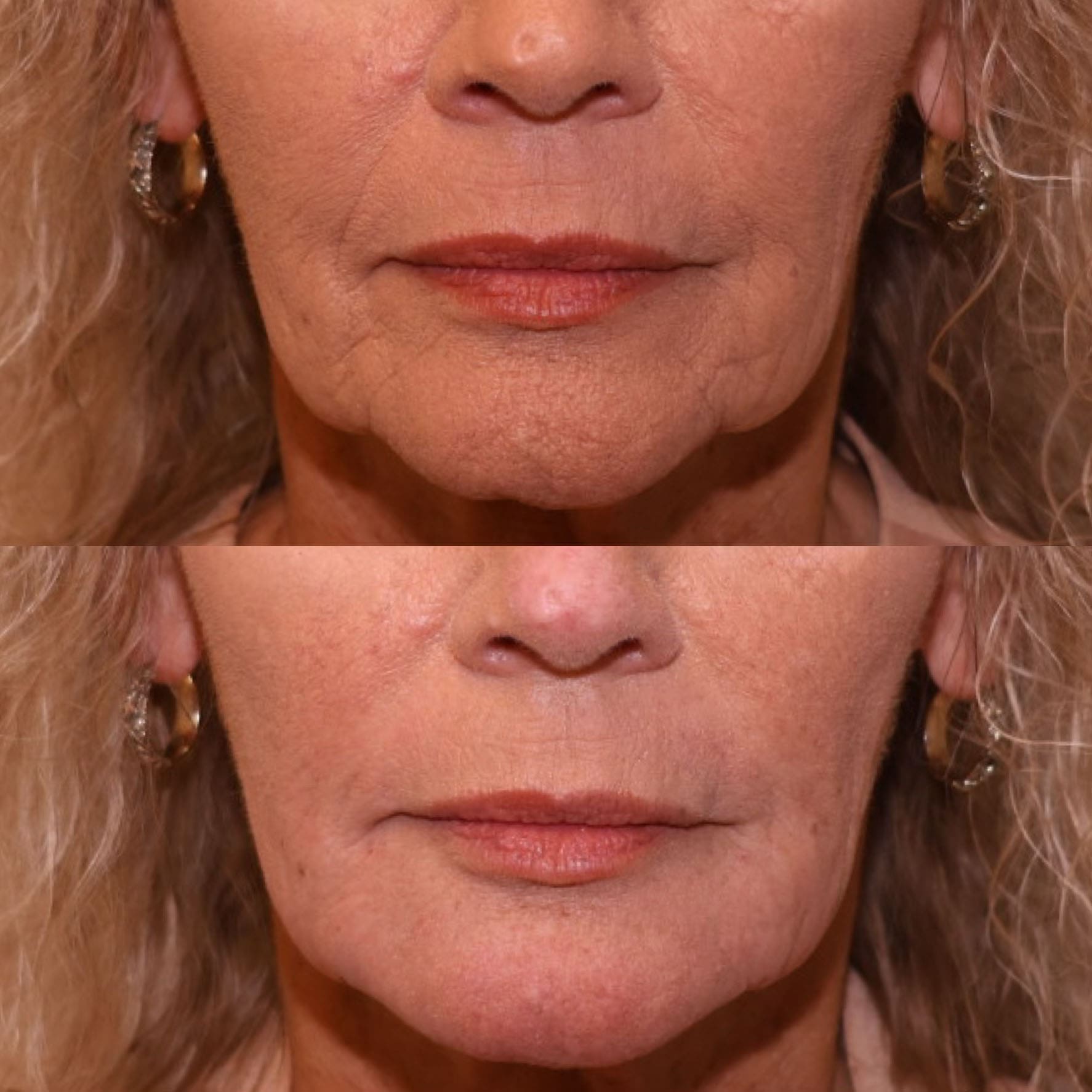 Patient before and after chin filler, front closeup view