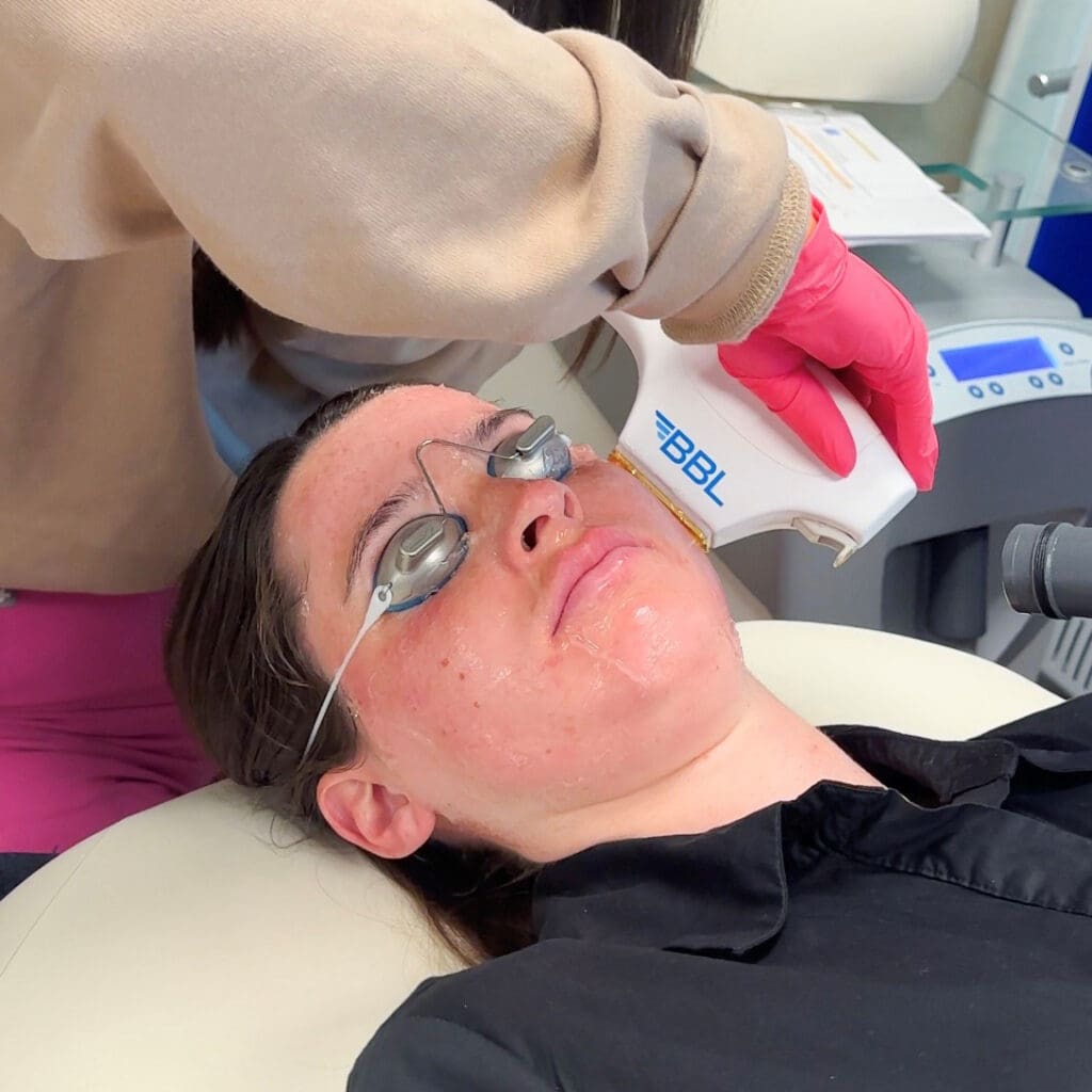 Patient wearing eye protection goggles and receiving a BBL treatment