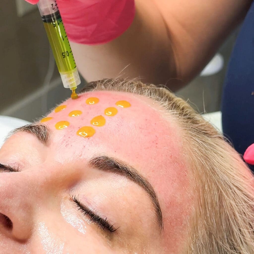 biorepeel-feat Medical practitioner administering PRP treatment to patient's forehead with yellow-gold droplets visible on skin surface and syringe with pink handle.